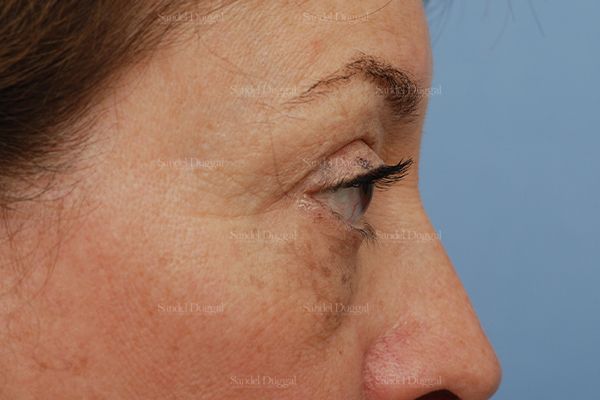 Eyelid Rejuvenation before, case 831