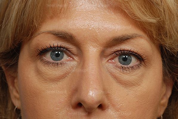 Eyelid Rejuvenation before, case 824