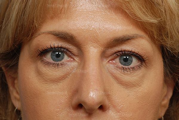 Eyelid Rejuvenation before, case 824