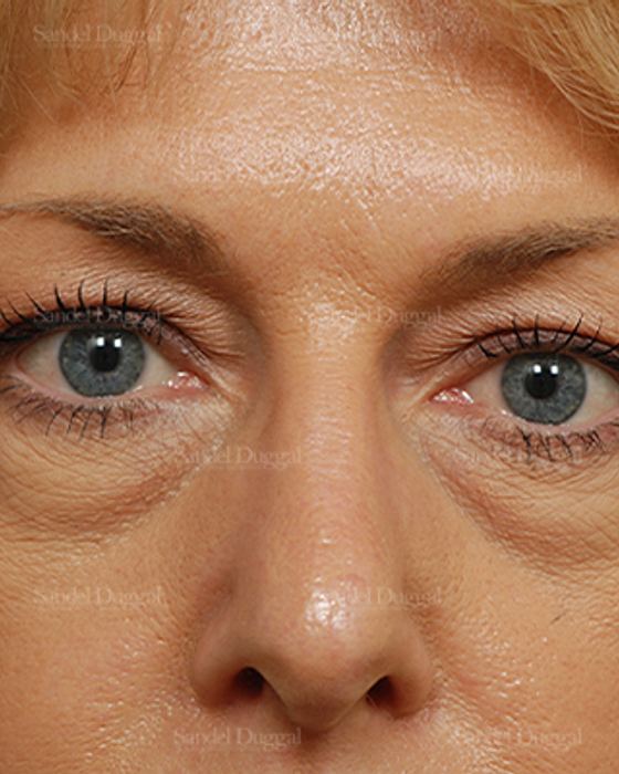 Eyelid Rejuvenation before, case 824