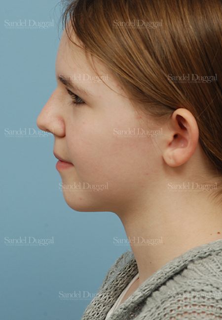 Otoplasty before, case 2598
