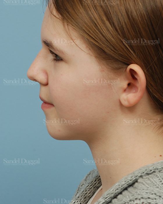Otoplasty before, case 2598