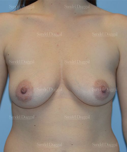 Breast Augmentation with Lift before, case 3379