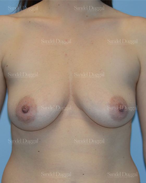 Breast Augmentation with Lift before, case 3379