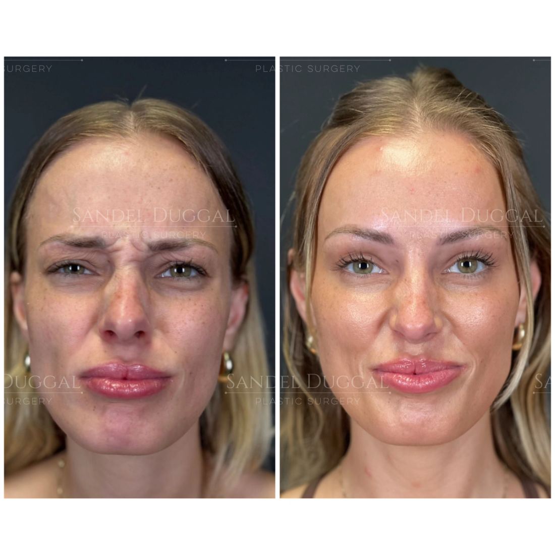 Botox & Fillers before and after, case 6012