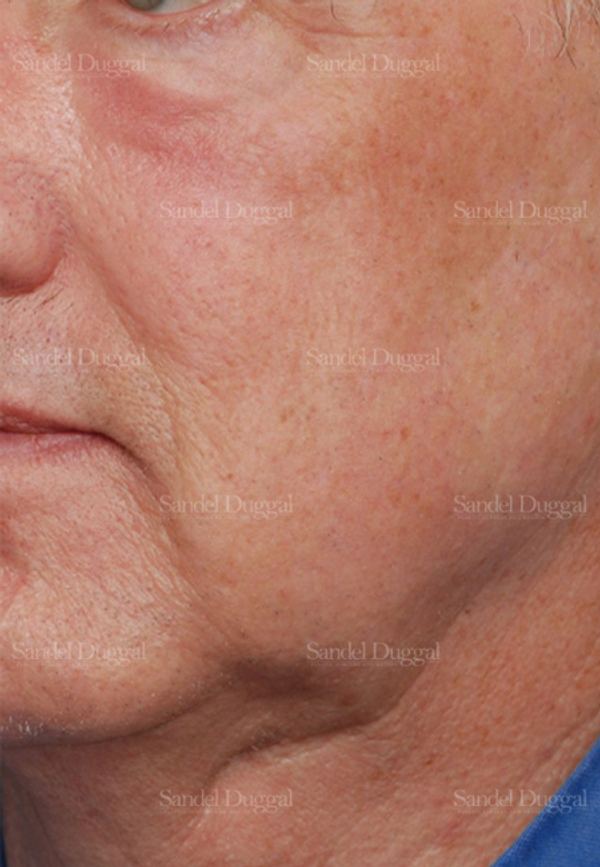 Laser Skin Resurfacing before, case 2926