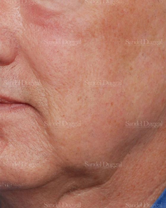 Laser Skin Resurfacing before, case 2926