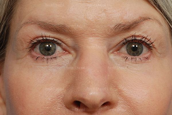 Eyelid Rejuvenation after, case 1912