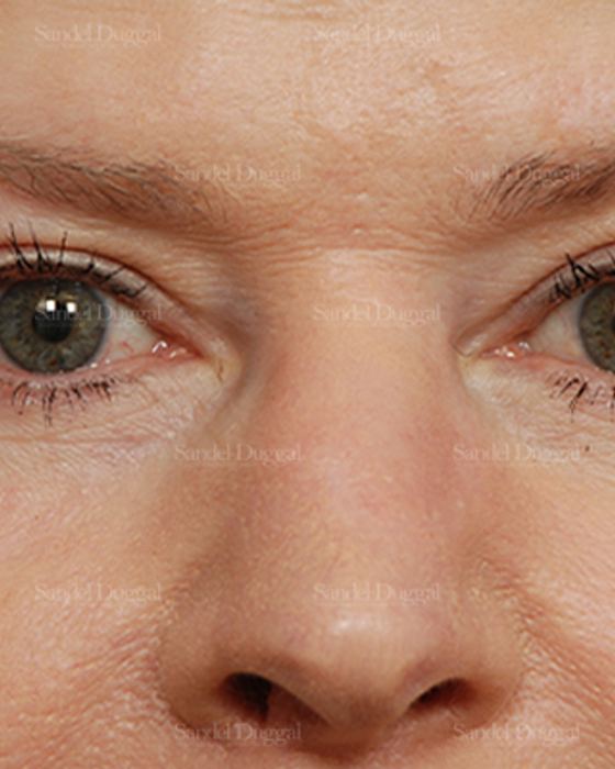 Eyelid Rejuvenation after, case 1912