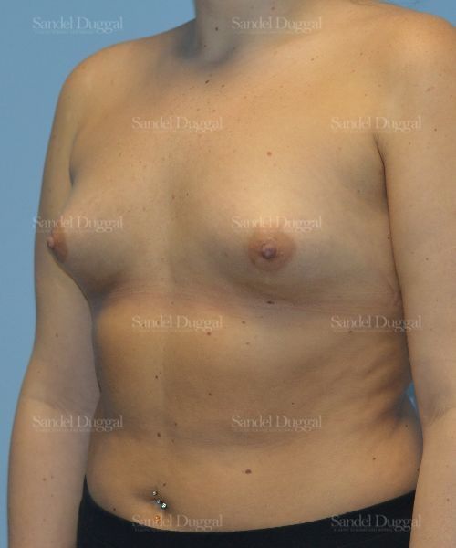 Breast Augmentation before, case 4756