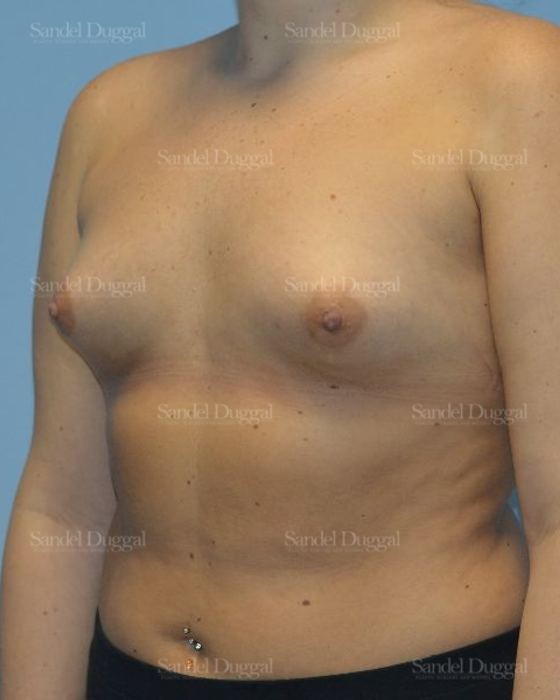 Breast Augmentation before, case 4756