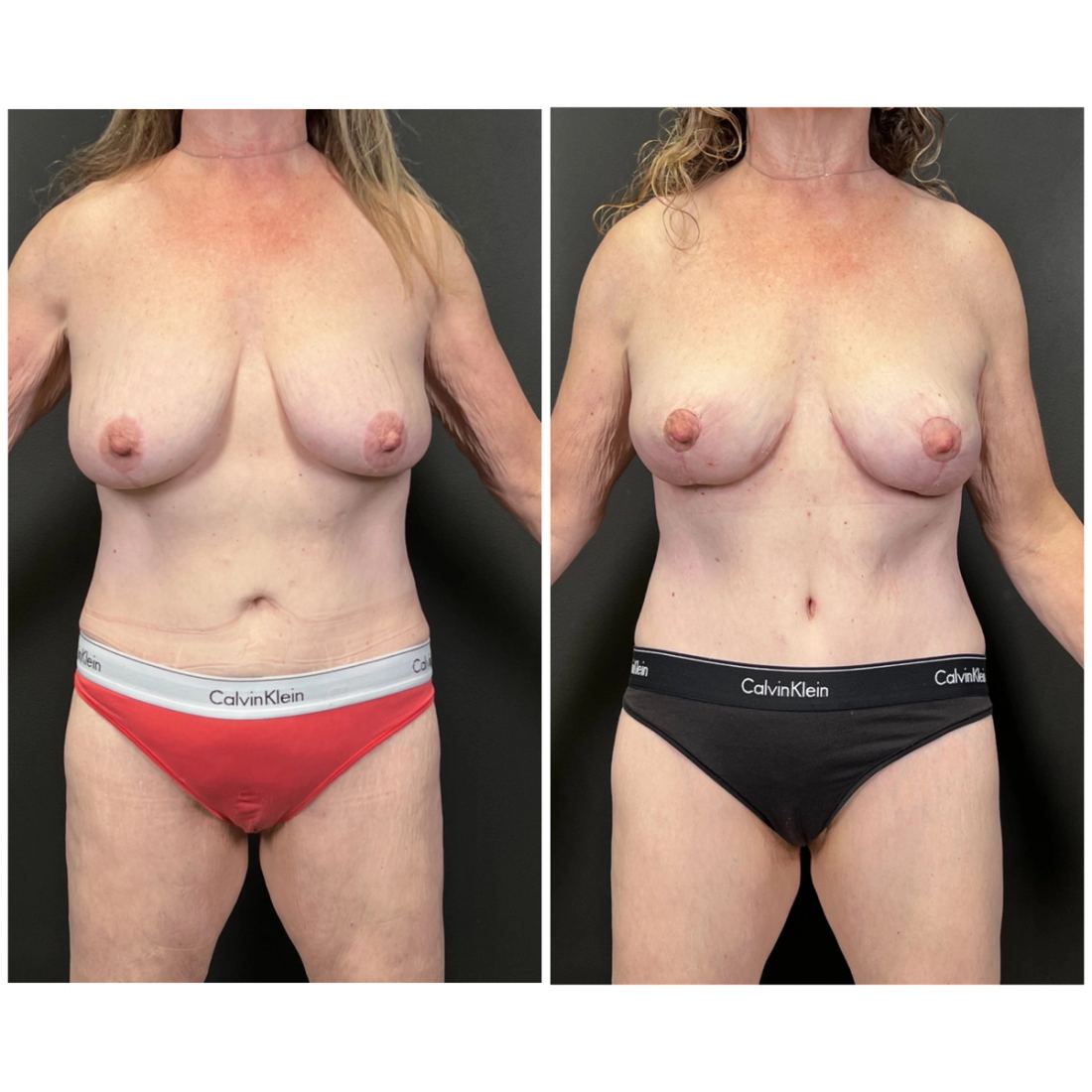 Mommy Makeover before and after, case mommy-makeover-03