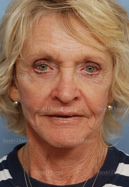 Cheek Augmentation after, case 1446