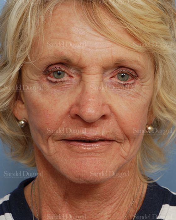 Cheek Augmentation after, case 1446