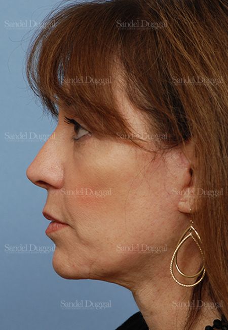 Facelift after, case 813