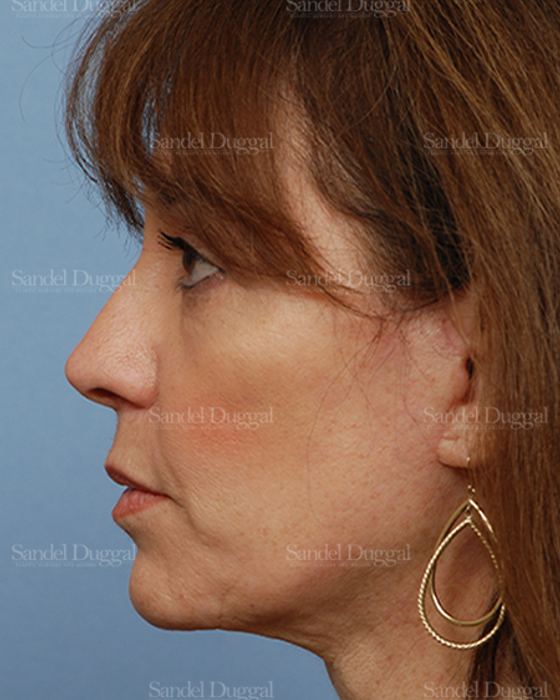 Facelift after, case 813
