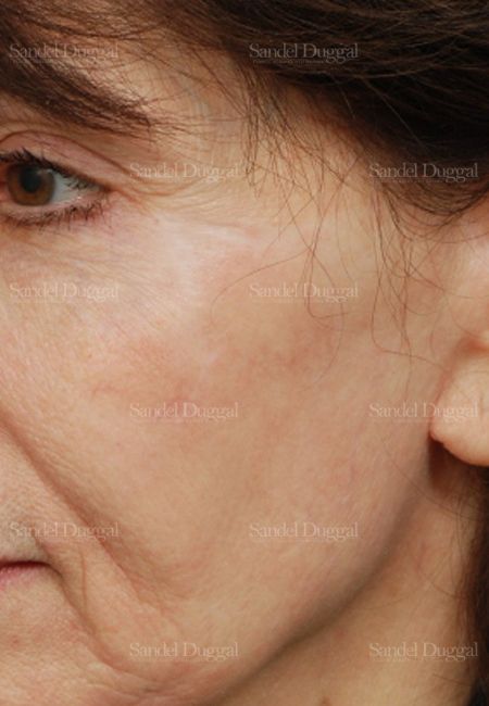 Reconstruction after Mohs after, case 2745
