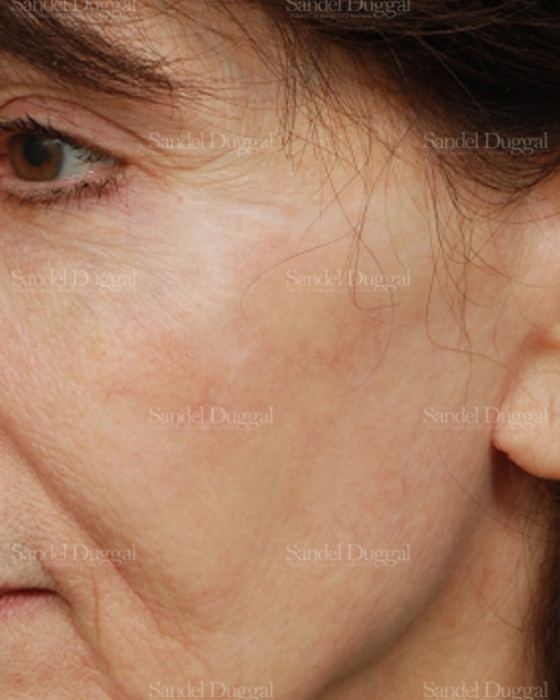 Reconstruction after Mohs after, case 2745