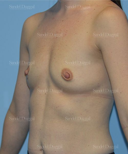 Breast Augmentation before, case 3178