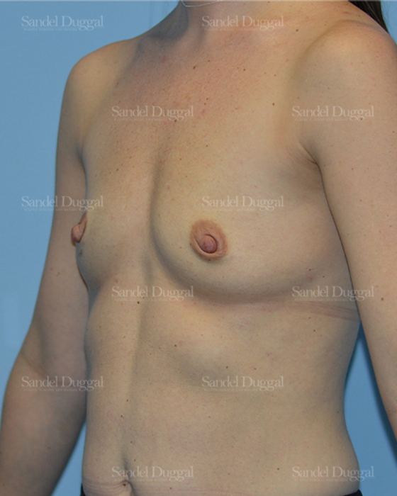 Breast Augmentation before, case 3178