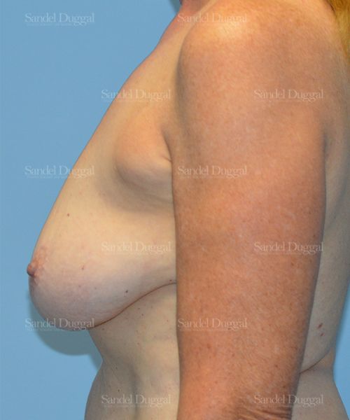 Breast Augmentation with Lift before, case 3372