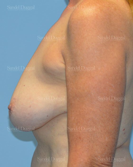Breast Augmentation with Lift before, case 3372