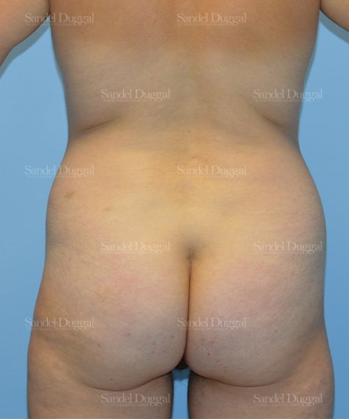 Tummy Tuck before, case 1643