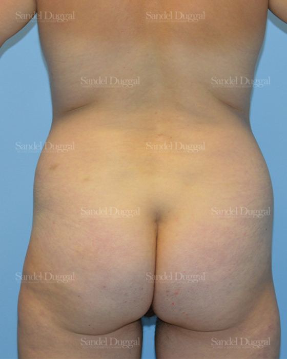 Tummy Tuck before, case 1643