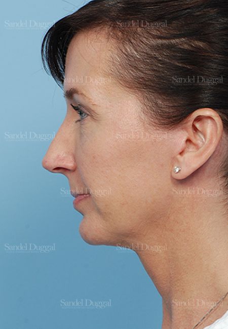 Facelift after, case 2647