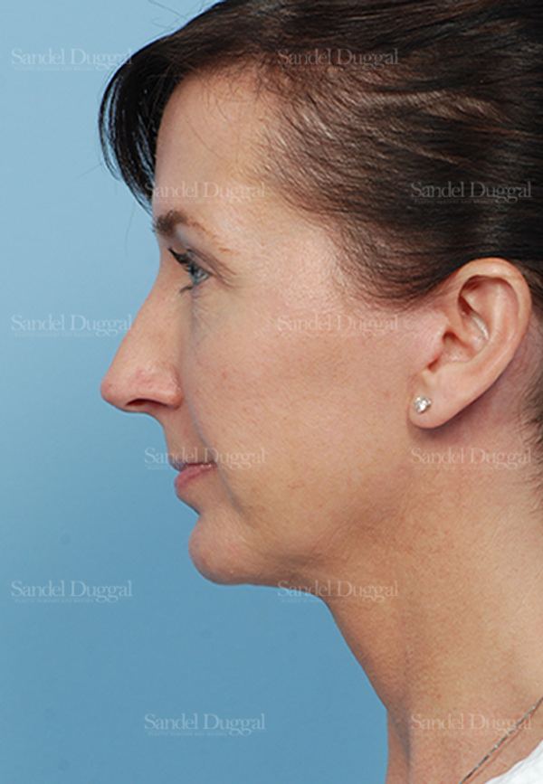 Facelift after, case 2647