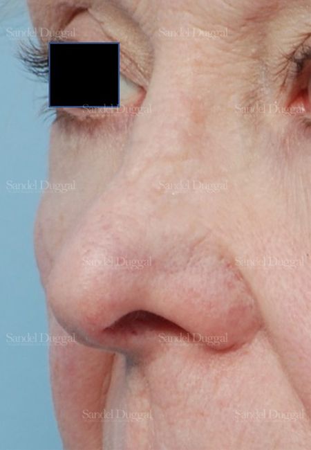 Revision Rhinoplasty before, case 2614
