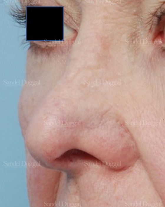 Revision Rhinoplasty before, case 2614