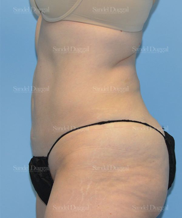 Liposuction — Abdomen after, case 2469