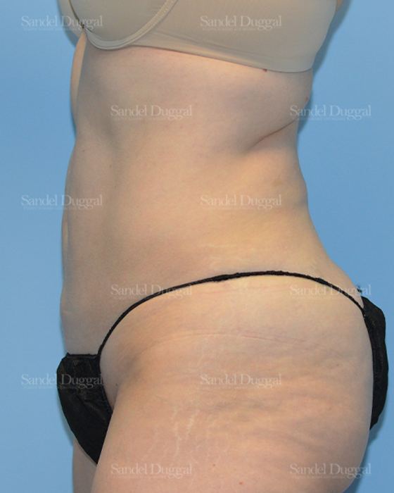 Liposuction — Abdomen after, case 2469