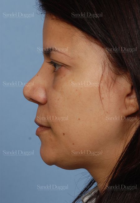Revision Rhinoplasty after, case 2621