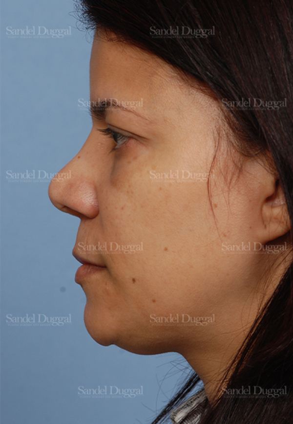 Revision Rhinoplasty after, case 2621