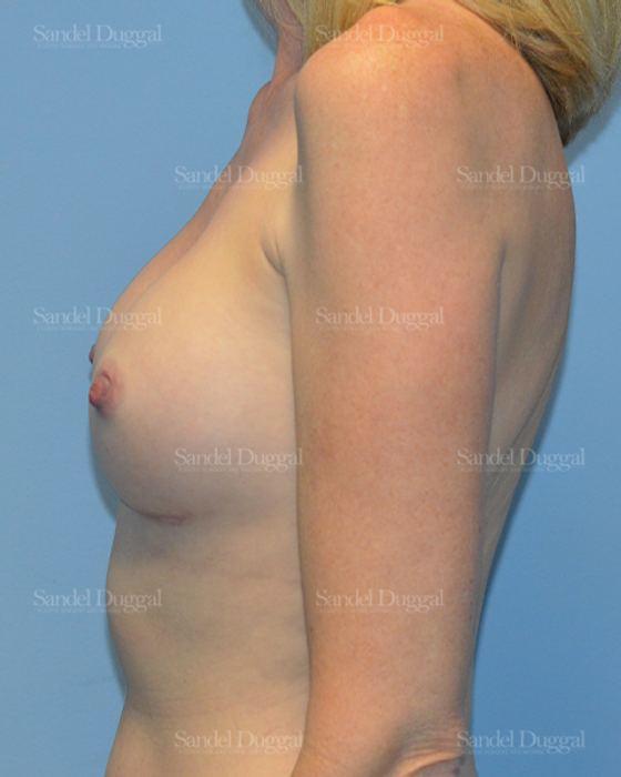 Breast Augmentation after, case 3241