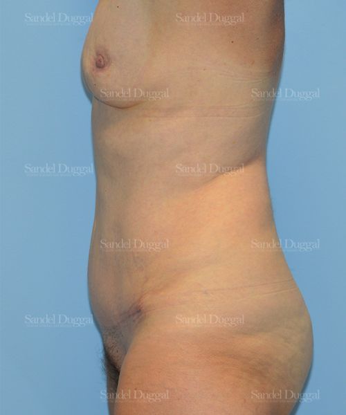 Tummy Tuck after, case 1687
