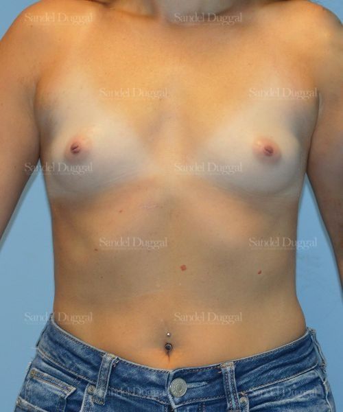 Breast Augmentation before, case 4764