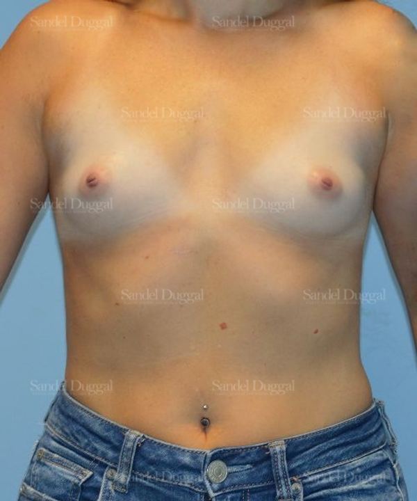 Breast Augmentation before, case 4764