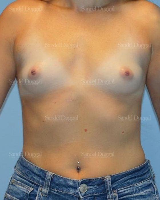 Breast Augmentation before, case 4764