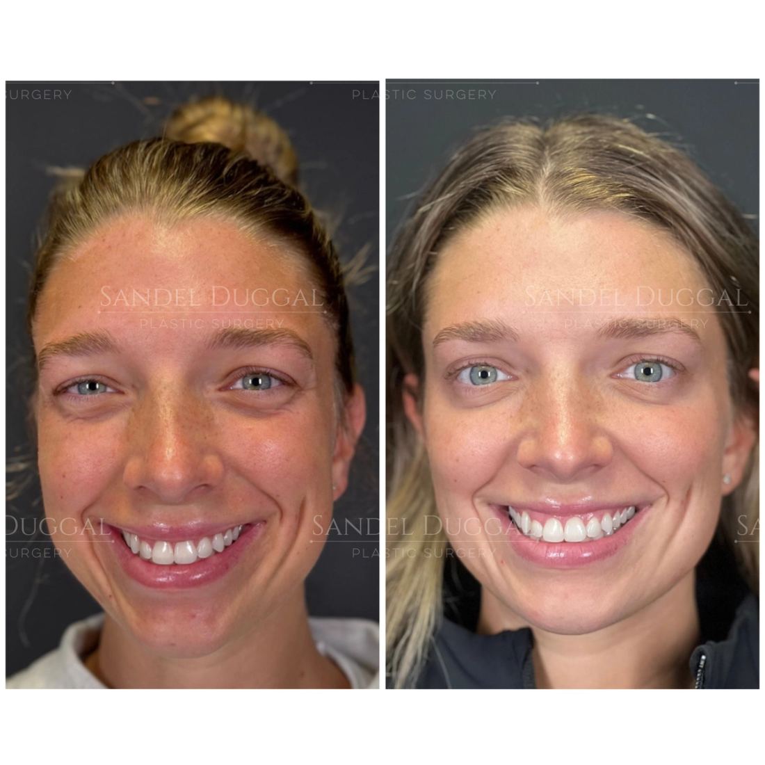 Botox & Fillers before and after, case 6009
