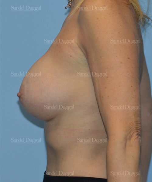 Breast Augmentation after, case 3262