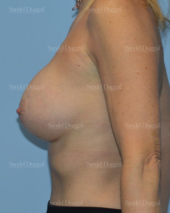Breast Augmentation after, case 3262