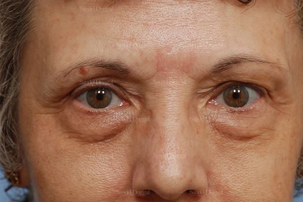 Eyelid Rejuvenation before, case 1907