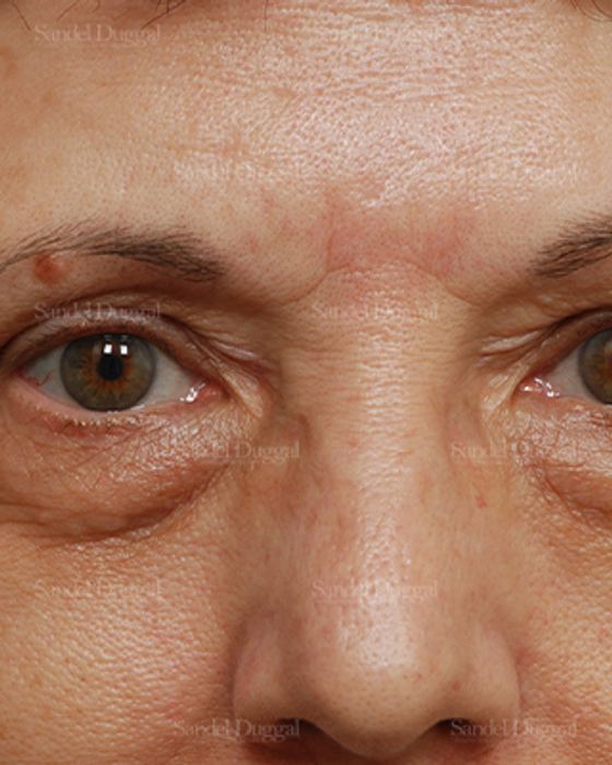 Eyelid Rejuvenation before, case 1907