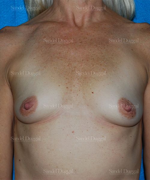 Breast Augmentation before, case 3248