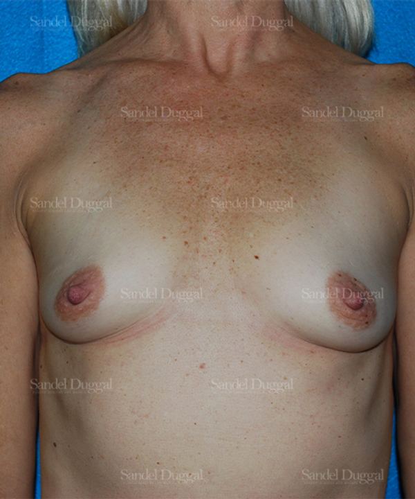 Breast Augmentation before, case 3248
