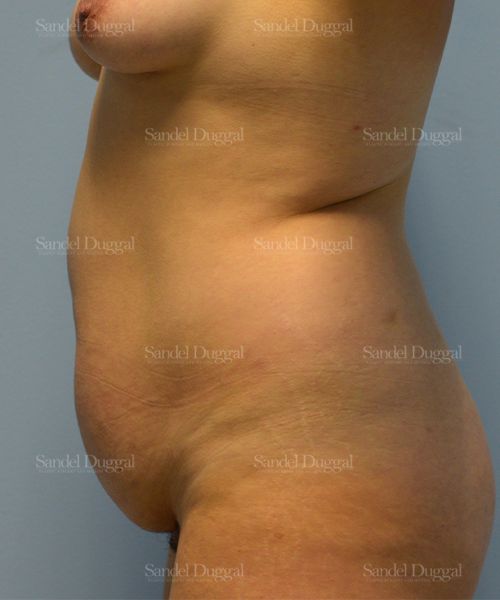 Tummy Tuck before, case 1643
