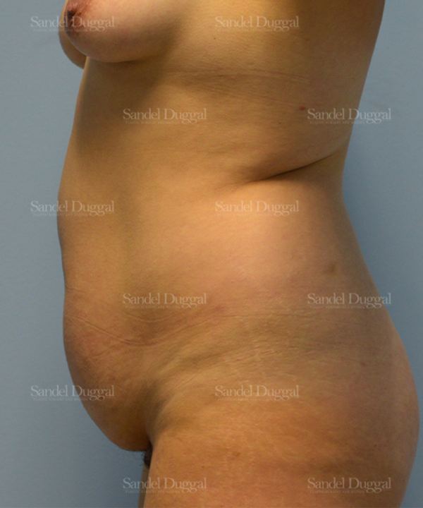 Tummy Tuck before, case 1643